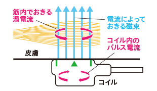 表層の痛覚神経刺激を低減。直接、深部の神経線維にアプローチ。